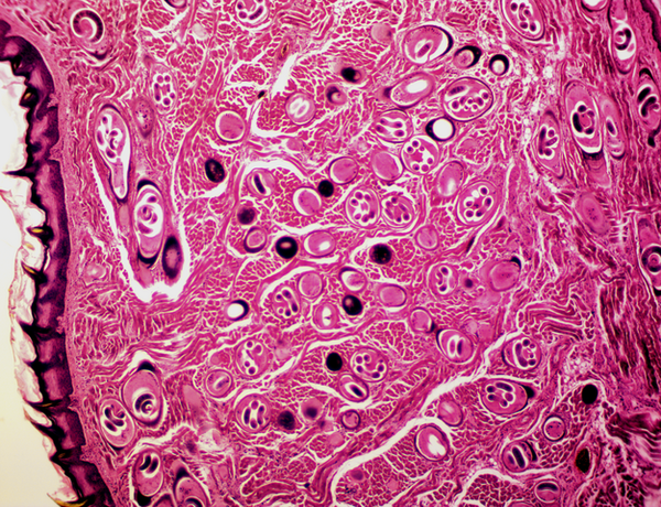 How likely is it that you will get Trichinosis from eating undercooked pork in the U.S?